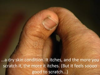 … a dry skin condition. It itches, and the more you scratch it, the more it itches. (But it feels soooo good to scratch...) 