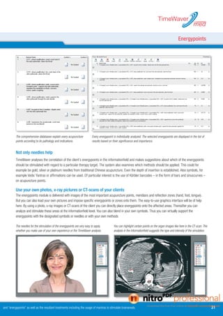 TimeWaver
                                                                                                                                                                    med

                                                                                                                                                       Energypoints




          The comprehensive databases explain every acupuncture             Every energypoint is individually analyzed. The selected energypoints are displayed in the list of
          points according to its pathology and indications.                results based on their significance and importance.


          Not only needles help
          TimeWaver analyses the correlation of the client’s energypoints in the informationfield and makes suggestions about which of the energypoints
          should be stimulated with regard to a particular therapy target. The system also examines which methods should be applied. This could for
          example be gold, silver or platinum needles from traditional Chinese acupuncture. Even the depth of insertion is established. Also symbols, for
          example Vedic Yantras or affirmations can be used. Of particular interest is the use of Körbler barcodes – in the form of bars and sinuscurves –
          on acupuncture points.

          Use your own photos, x-ray pictures or CT-scans of your clients
          The energypoints module is delivered with images of the most important acupuncture points, meridians and reflection zones (hand, foot, tongue).
          But you can also load your own pictures and impose specific energypoints or zones onto them. The easy-to-use graphics interface will be of help
          here. By using a photo, x-ray images or CT-scans of the client you can directly place energypoints onto the affected areas. Thereafter you can
          analyze and stimulate these areas at the informationfield level. You can also blend in your own symbols. Thus you can virtually support the
          energypoints with the designated symbols or needles or with your own methods

          The needles for the stimulation of the energypoints are very easy to apply,         You can highlight certain points on the organ images like here in the CT-scan. The
          whether you make use of your own experience or the TimeWaver analysis.              analysis in the informationfield suggests the type and intensity of the simulation.




and “energypoints” as well as the resultant treatments including the usage of mantras to stimulate brainareals.                                                                     1
 