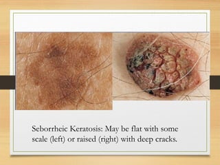 skin tumors (pathological slides) skin pathologies | PPTX