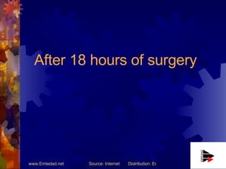 After 18 hours of surgery 