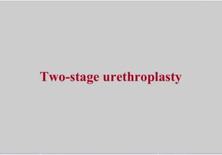 Two stage urethroplasty of bulbar urethra
