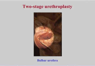 Two stage urethroplasty of bulbar urethra | PDF