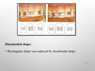 Rhomboidal Two By Four Appliance in Pediatric Dentistry | PPTX