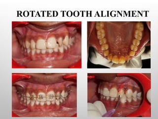 Teeth Alignment Rotations Two By Four Appliance in Pediatric Dentistry | PPTX