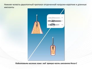 Нижняя челюсть-двухэтапный протокол отсроченной нагрузки-короткие и длинные
импланты




          Подготовьте костное ложе под прямую часть импланта Perso-C
 