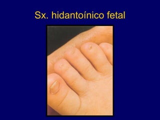 Sx. hidantoínico fetal
 