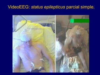 VideoEEG: status epilepticus parcial simple.
 
