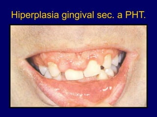 Hiperplasia gingival sec. a PHT.
 