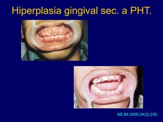 Hiperplasia gingival sec. a PHT.
NEJM 2000;34(2):235.
 