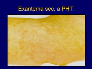 Exantema sec. a PHT.
 