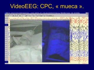 VideoEEG: CPC, « mueca ».
 