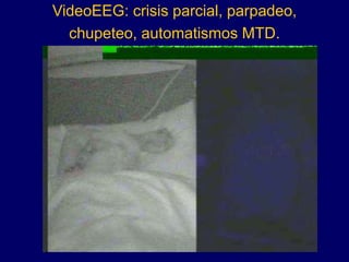 VideoEEG: crisis parcial, parpadeo,
chupeteo, automatismos MTD.
 