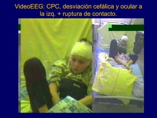 VideoEEG: CPC, desviación cefálica y ocular a
la izq. + ruptura de contacto.
 