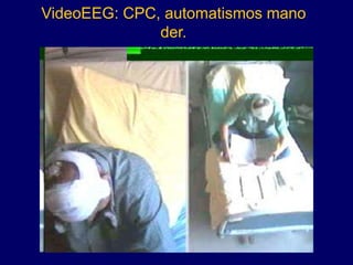 VideoEEG: CPC, automatismos mano
der.
 