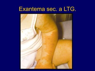 Exantema sec. a LTG.
 
