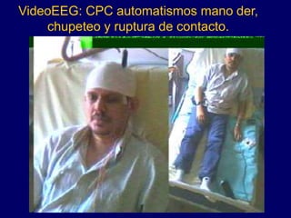 VideoEEG: CPC automatismos mano der,
chupeteo y ruptura de contacto.
 