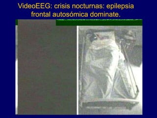 VideoEEG: crisis nocturnas: epilepsia
frontal autosómica dominate.
 