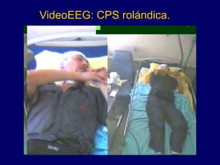 VideoEEG: CPS rolándica.
 