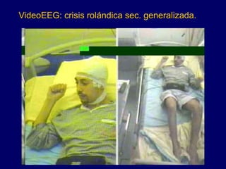 VideoEEG: crisis rolándica sec. generalizada.
 