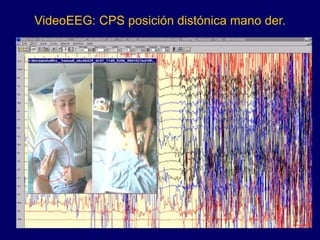VideoEEG: CPS posición distónica mano der.
 