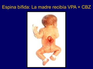 Espina bífida: La madre recibía VPA + CBZ
 