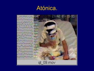 Atónica.
 