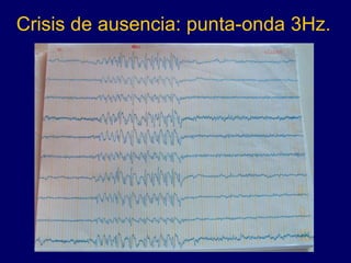 Crisis de ausencia: punta-onda 3Hz.
 