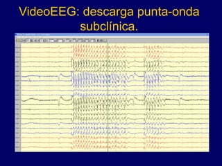 VideoEEG: descarga punta-onda
subclínica.
 