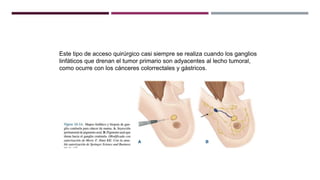 Este tipo de acceso quirúrgico casi siempre se realiza cuando los ganglios
linfáticos que drenan el tumor primario son adyacentes al lecho tumoral,
como ocurre con los cánceres colorrectales y gástricos.
 