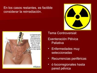 En los casos restantes, es factible considerar la reirradiación. Tema Controversial: Exenteración Pélvica Paliativa Enfermedades muy seleccionadas Recurrencias periféricas ó locorregionales hasta pared pélvica 
