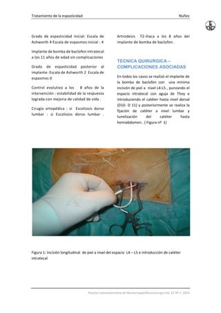 Baclofeno intratecal precio