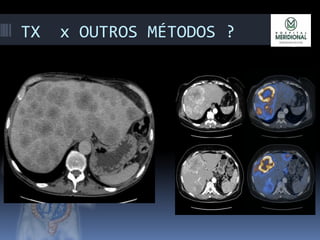 TX x OUTROS MÉTODOS ?
 
