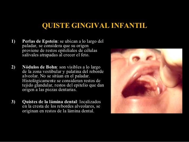 quistes odontogenicos y no odontogenicos
