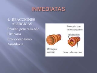 4.- REACCIONES
    ALERGICAS
Prurito generalizado
Urticaria
Broncoespasmo
Anafilaxia
 