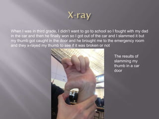 When I was in third grade, I didn’t want to go to school so I fought with my dad
in the car and then he finally won so I got out of the car and I slammed it but
my thumb got caught in the door and he brought me to the emergency room
and they x-rayed my thumb to see if it was broken or not

                                                            The results of
                                                            slamming my
                                                            thumb in a car
                                                            door
 