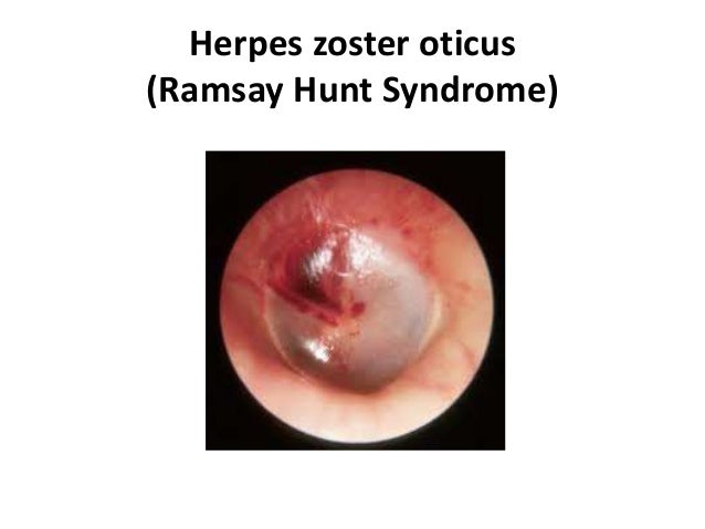 Tympanic membrane
