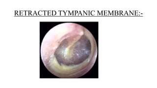 Timpanic Mem Retraction tympanic membrane.pptx