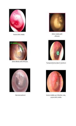 Acute otitis media 
Otitis media with effusion 
Otitis Media with Effusion 
Tympanostomy tube in eardrum 
Normal eardrum 
Acute middle-ear infection, aka, acute otitis media  
