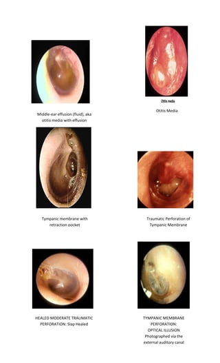 Middle-ear effusion (fluid), aka otitis media with effusion 
Otitis Media 
Tympanic membrane with retraction pocket 
Traumatic Perforation of Tympanic Membrane 
TYMPANIC MEMBRANE PERFORATION: OPTICAL ILLUSION Photographed via the external auditory canal 
HEALED MODERATE TRAUMATIC PERFORATION: Slap Healed  