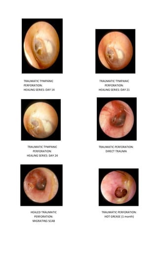 TRAUMATIC TYMPANIC PERFORATION: HEALING SERIES: DAY 14 
TRAUMATIC TYMPANIC PERFORATION: HEALING SERIES: DAY 21 
TRAUMATIC TYMPANIC PERFORATION: HEALING SERIES: DAY 24 
TRAUMATIC PERFORATION: DIRECT TRAUMA 
HEALED TRAUMATIC PERFORATION: MIGRATING SCAB 
TRAUMATIC PERFORATION: HOT GREASE (1 month)  