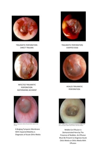 TRAUMATIC PERFORATION: DIRECT TRAUMA 
TRAUMATIC PERFORATION: EVERTED EDGE 
INFECTED TRAUMATIC PERFORATION: WATERSKIING ACCIDENT 
HEALED TRAUMATIC PERFORATION: NEW BLOOD VESSELS 
A Bulging Tympanic Membrane With Impaired Mobility is Diagnostic of Acute Otitis Media 
Middle Ear Effusion is Demonstrated Here by The Presence of Bubbles. An Effusion Must Be Present to Diagnose Acute Otitis Media or Otitis Media With Effusion  