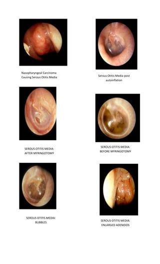 Serous Otitis Media-post autoinflation 
Nasopharyngeal Carcinoma Causing Serous Otitis Media 
SEROUS OTITIS MEDIA: BEFORE MYRINGOTOMY 
SEROUS OTITIS MEDIA: AFTER MYRINGOTOMY 
SEROUS OTITIS MEDIA: ENLARGED ADENOIDS 
SEROUS OTITIS MEDIA: BUBBLES  