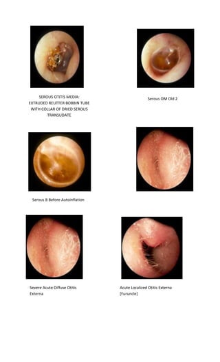SEROUS OTITIS MEDIA: EXTRUDED REUTTER BOBBIN TUBE WITH COLLAR OF DRIED SEROUS TRANSUDATE 
Serous OM Old 2 
Serous B Before Autoinflation 
Severe Acute Diffuse Otitis Externa 
Acute Localized Otitis Externa [Furuncle]  