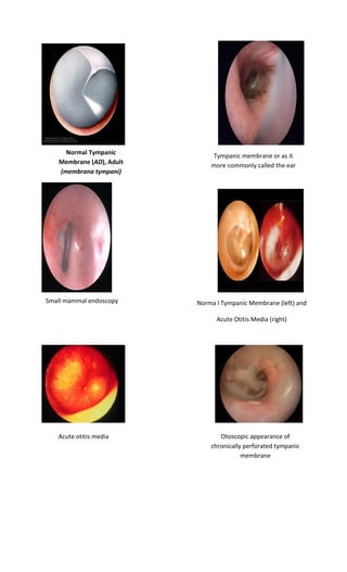 Normal Tympanic Membrane (AD), Adult (membrana tympani) 
Tympanic membrane or as it more commonly called the ear drum 
Norma l Tympanic Membrane (left) and 
Acute Otitis Media (right) 
Small mammal endoscopy 
Acute otitis media 
Otoscopic appearance of chronically perforated tympanic membrane  