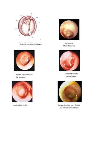 Normal tympanic membrane 
Congenital Cholesteatoma 
Normal appearance of the tympanic membrane 
Acute otitis media with effusion 
Acute otitis media 
Purulent middle ear effusion and tympanic membrane  