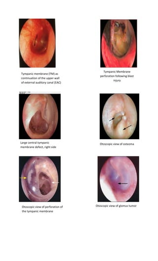Tympanic membrane (TM) as continuation of the upper wall of external auditory canal (EAC) with angle of incline up to 45 degrees on the border between middle ear and the EAC 
Tympanic Membrane perforation following blast injury 
Large central tympanic membrane defect, right side 
Otoscopic view of osteoma 
Otoscopic view of perforation of the tympanic membrane 
Otoscopic view of glomus tumor  