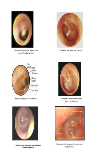Ulcerated Tympanic Membrane and Deep Canal Skin 
TYMPANIC MEMBRANE CRUST 
Normal Tympanic Membrane 
Atelectatic tympanic membrane with fluid level 
Tympanic membrane defect with calcification 
Posterior left tympanic membrane perforation  
