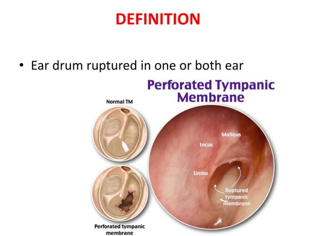 Tympanic membrane perforation | PPTX