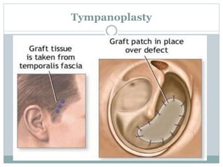 Tympanoplasty
 