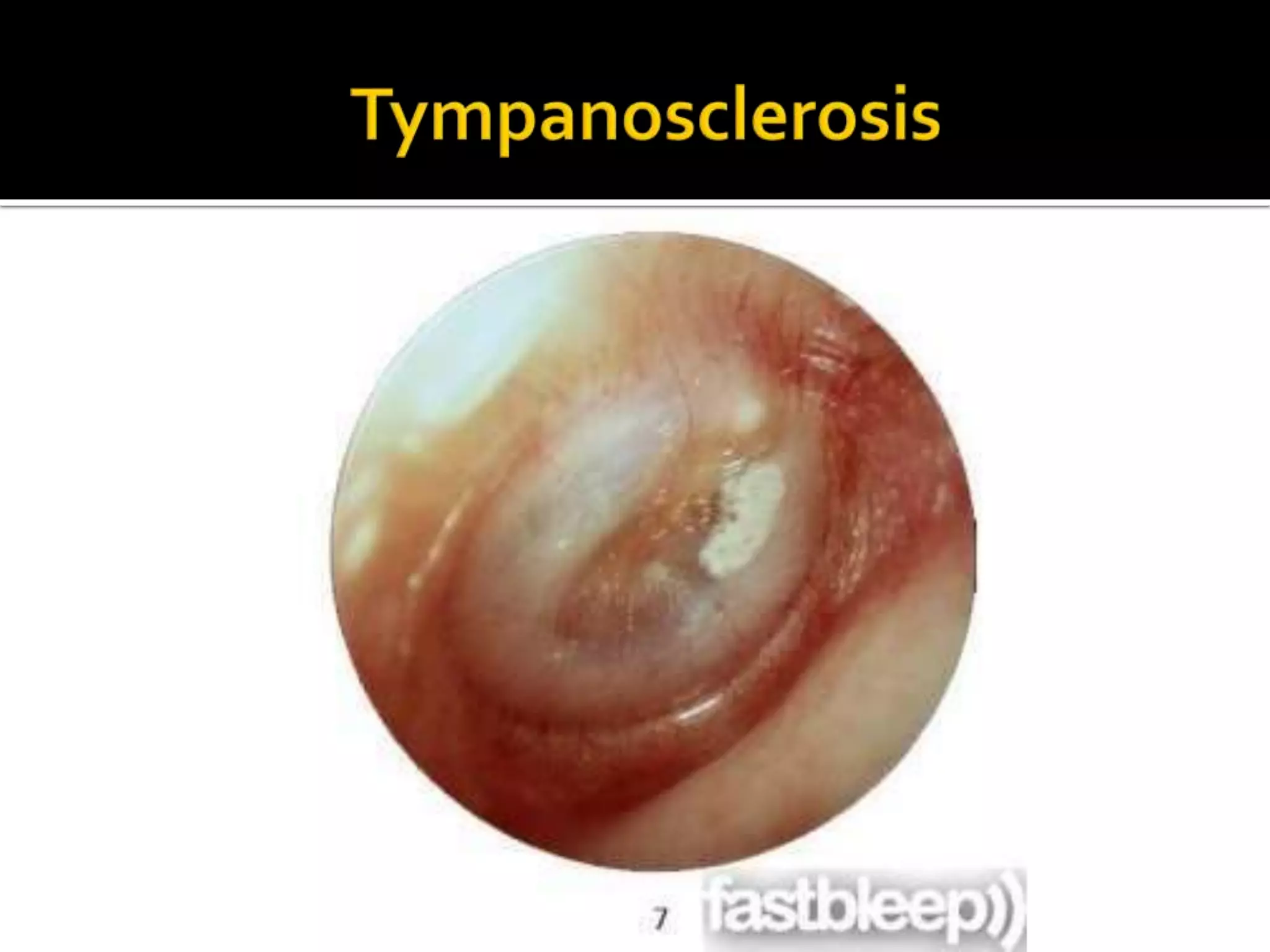 Tympanic Membrane ppt.pptx